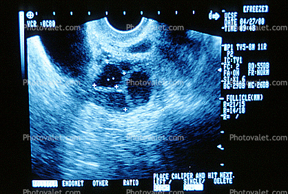 Ultrasound Scan, Ultra-sound