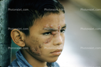 Boy with Skin Disease