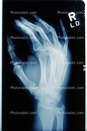 X-Ray, Hand, Carpal Tunnel Syndrome