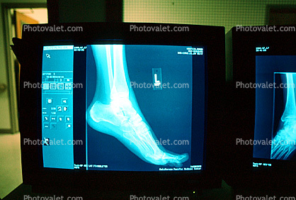 foot, X-Ray, Foot