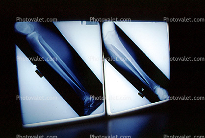 leg bone, X-Ray