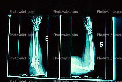 arm, hand, X-Ray, Carpal Tunnel Syndrome