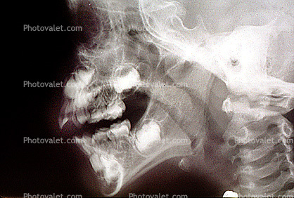jaw, X-Ray