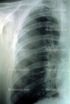 ribs, X-Ray