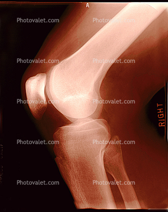 elbow, X-Ray