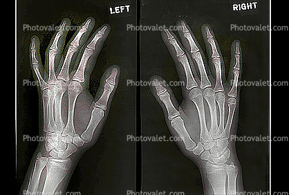 hand, fingers, knuckles, X-Ray