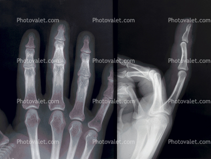 hand, fingers, knuckles, X-Ray