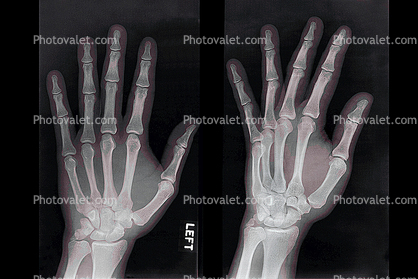 hand, fingers, X-Ray