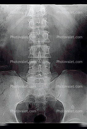 pelvis, back, vertebrae, spine, X-Ray