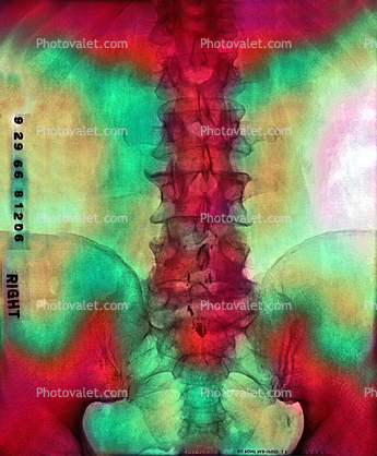 pelvis, back, vertebrae, spine, X-Ray