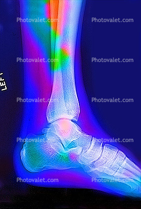 Ankle, leg, foot, X-Ray