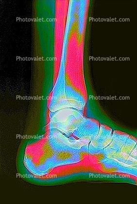 leg, foot, X-Ray