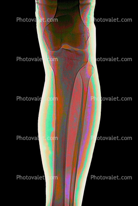 leg, knee, X-Ray