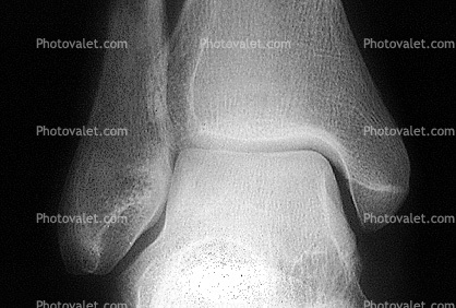 ankle, X-Ray
