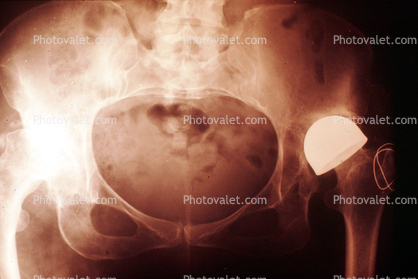Hip Bone, Pelvis, X-Ray