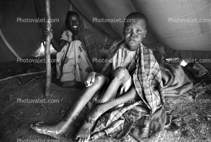 Leprosy, Refugee Camp, near the Ethiopia Somalia border, African Diaspora, Somalia