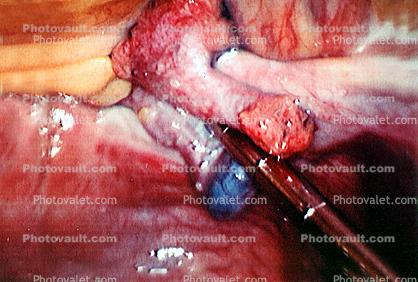 ovary, fallopian tube