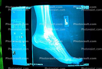 foot, X-Ray, Foot