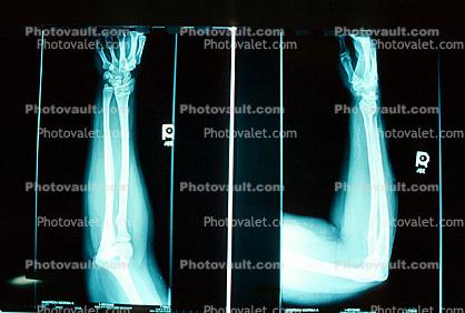 arm, hand, X-Ray