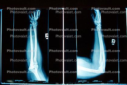 arm, hand, X-Ray, Carpal Tunnel Syndrome
