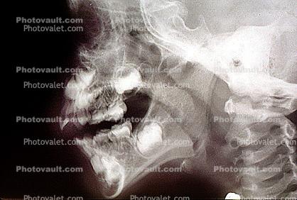 jaw, X-Ray