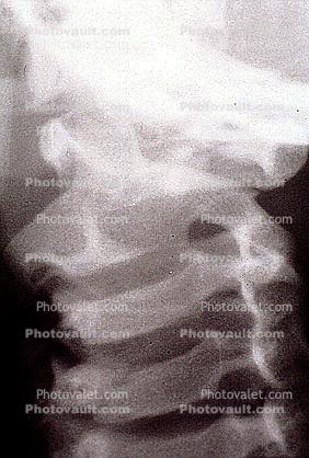 neck, vertebrae, X-Ray