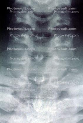 neck, vertebrae, X-Ray