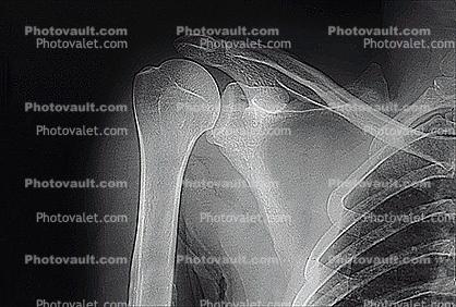 shoulder, X-Ray