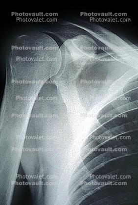 shoulder, X-Ray