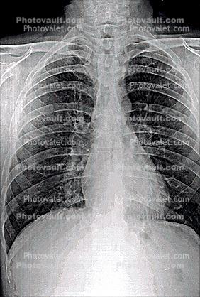ribs, X-Ray