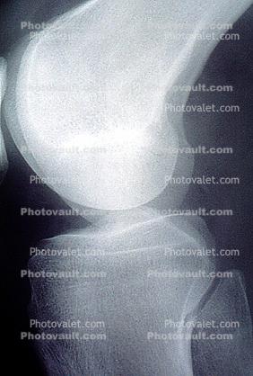 elbow, X-Ray