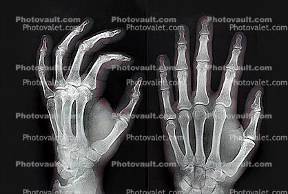 hand, fingers, knuckles, X-Ray, Carpal Tunnel Syndrome