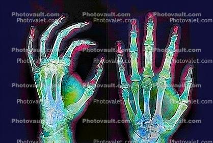 hand, fingers, knuckles, X-Ray, Carpal Tunnel Syndrome