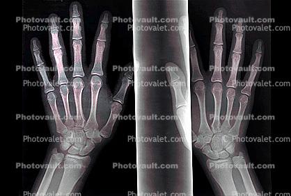 hand, fingers, knuckles, X-Ray