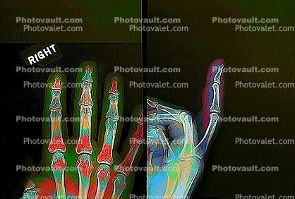 hand, fingers, knuckles, X-Ray