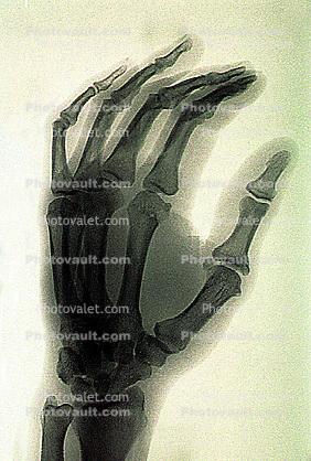 hand, fingers, X-Ray