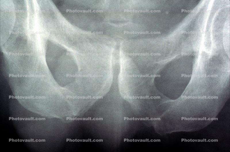 Hip Bone, Pelvis, X-Ray