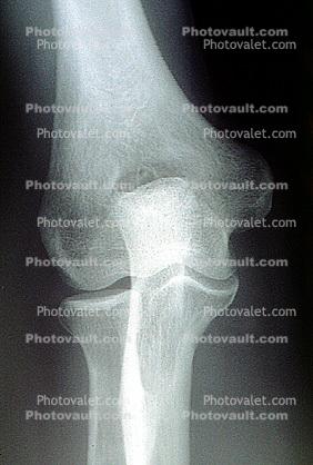 knee, X-Ray