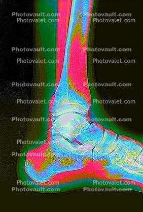 leg, foot, X-Ray