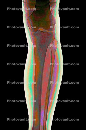 leg, knee, X-Ray