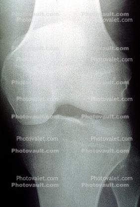 knee, X-Ray