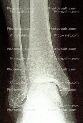 ankle, X-Ray