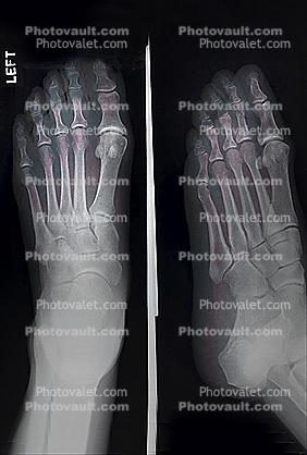 foot, toes, X-Ray