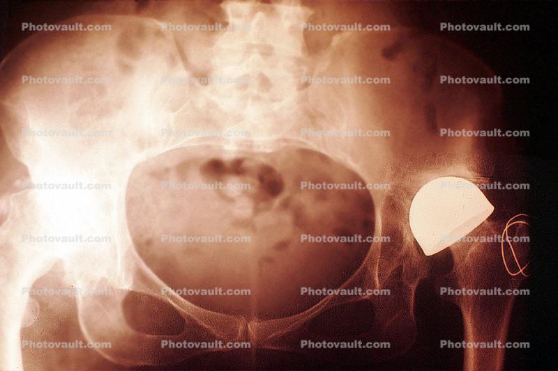 Hip Bone, Pelvis, Socket, Artificial Socket, X-Ray
