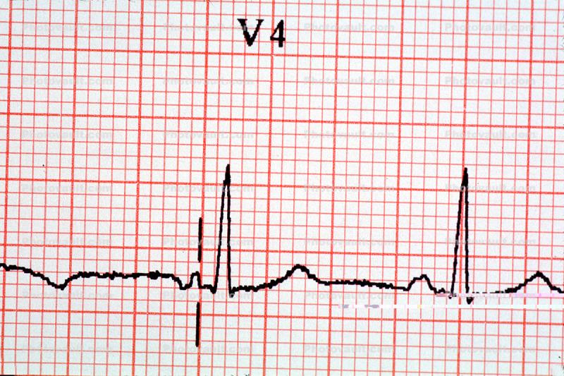 Spike, Heart and Pulse rate chart, ECG