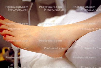 swollen foot, fracture