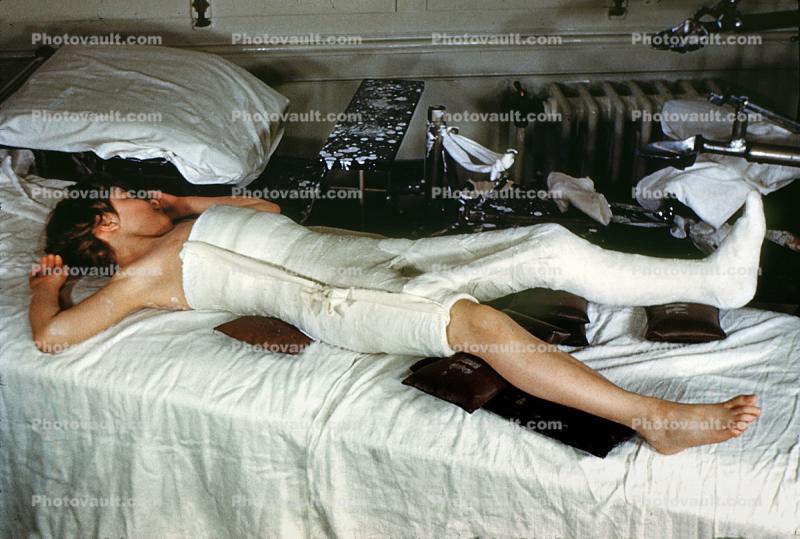 Spicacast, Patient in a body cast, Traction, 1949, 1940s