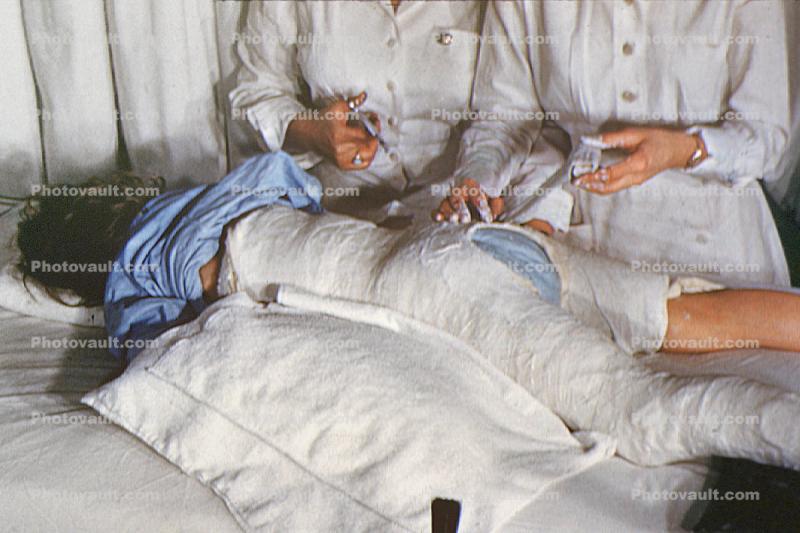 Patient in a body cast, 1949, 1940s, Spicacast