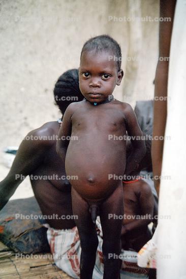 Malnourished Boy
