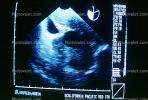 Ultrasound Scan, Ultra-sound, HAFV01P02_01B